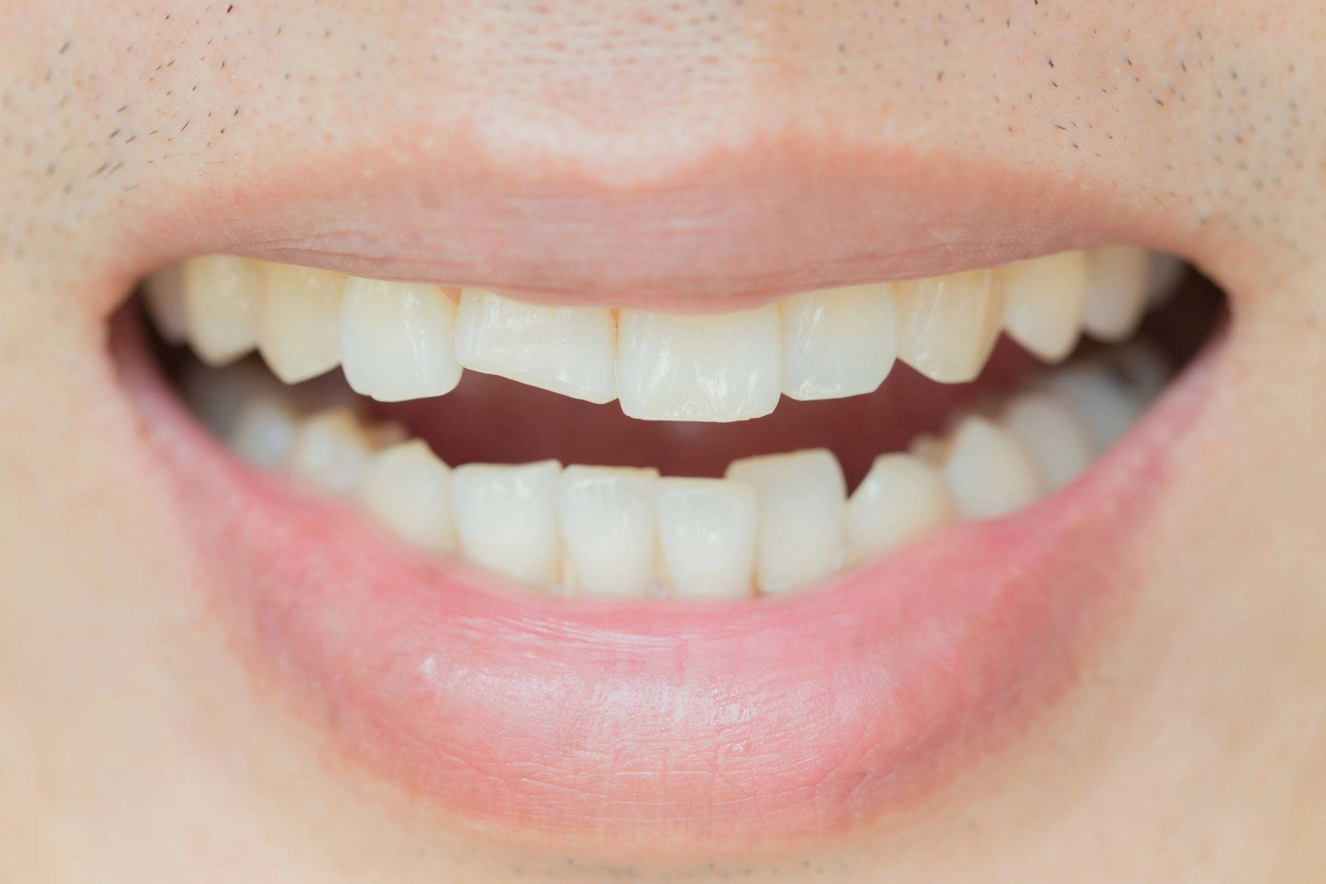 Close-up of a set of teeth that have been chipped in the front
