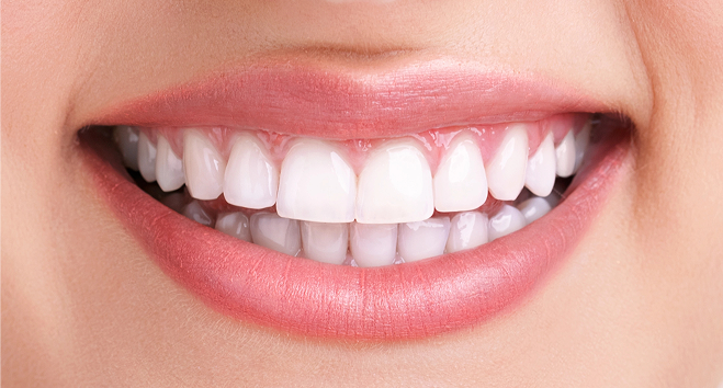 Close-up showing bright white teeth after professional dental whitening treatment – after photo