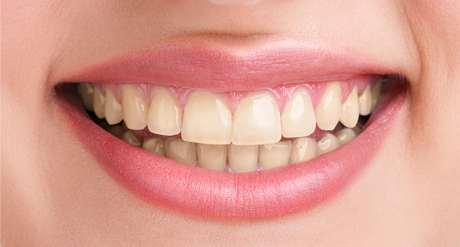 Close-up showing bright white teeth after professional dental whitening treatment – before photo