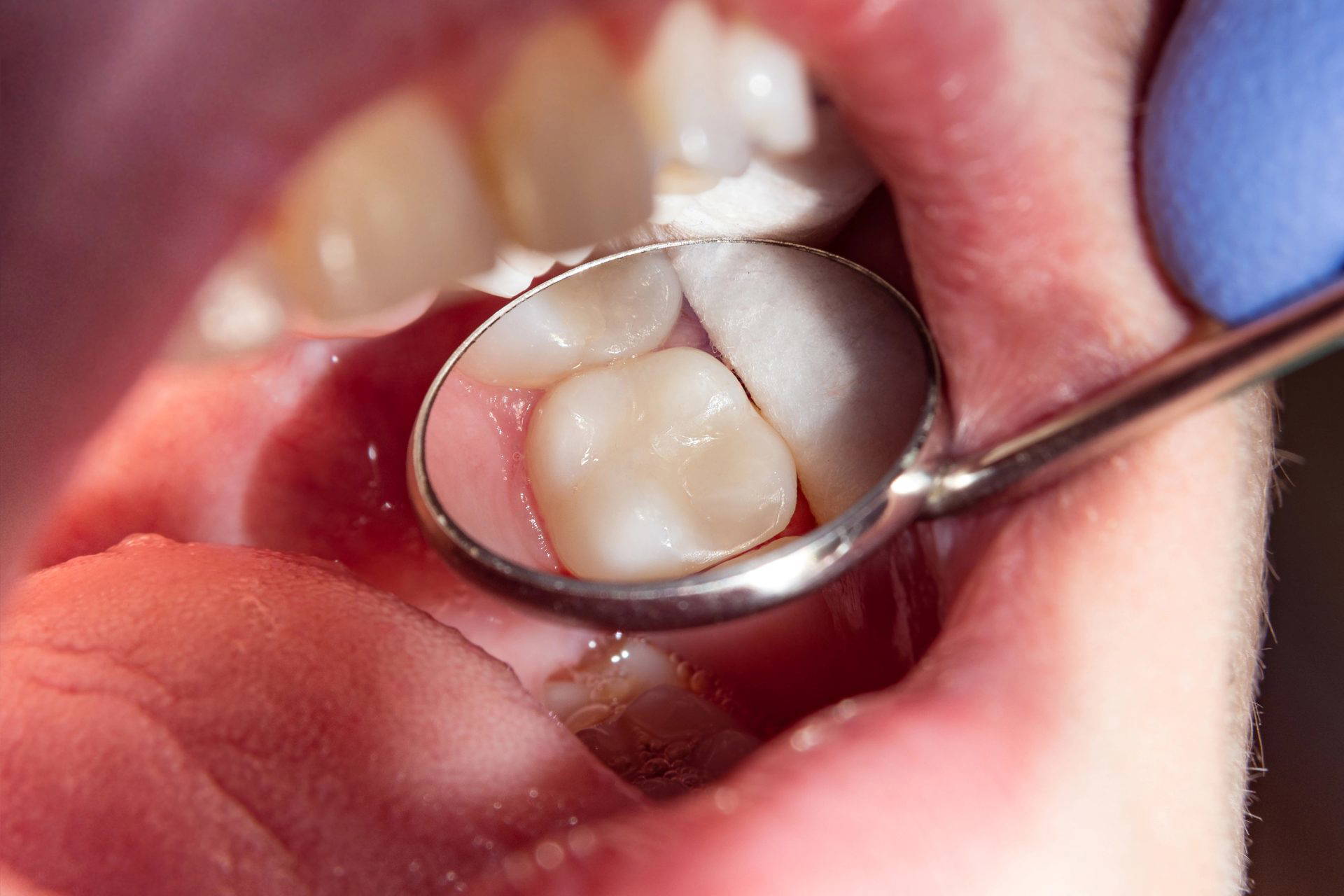 Dental probe examining a tooth during a check-up
