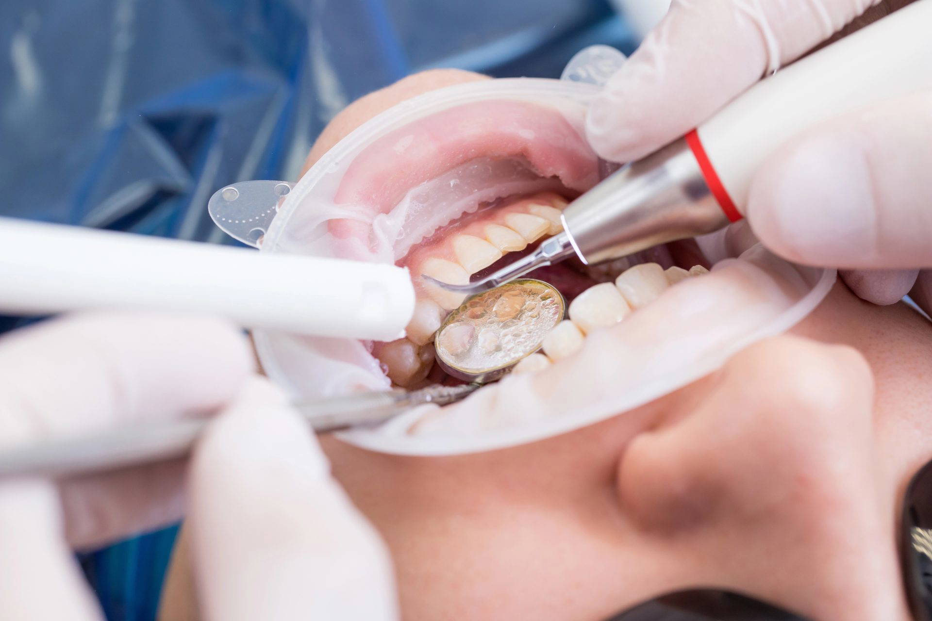 Dentist using tools during a dental hygiene treatment on a patient