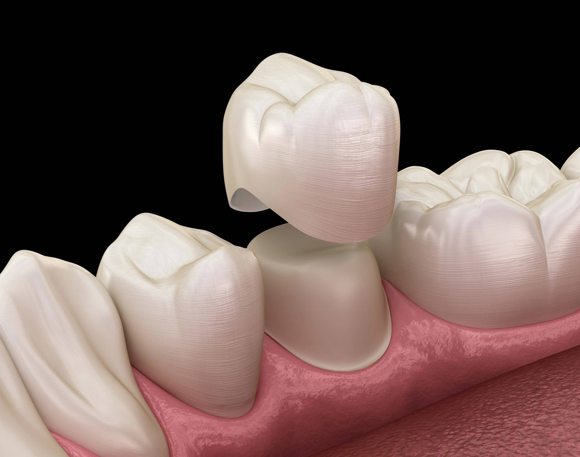 White dental crown placed on a model tooth with tools nearby