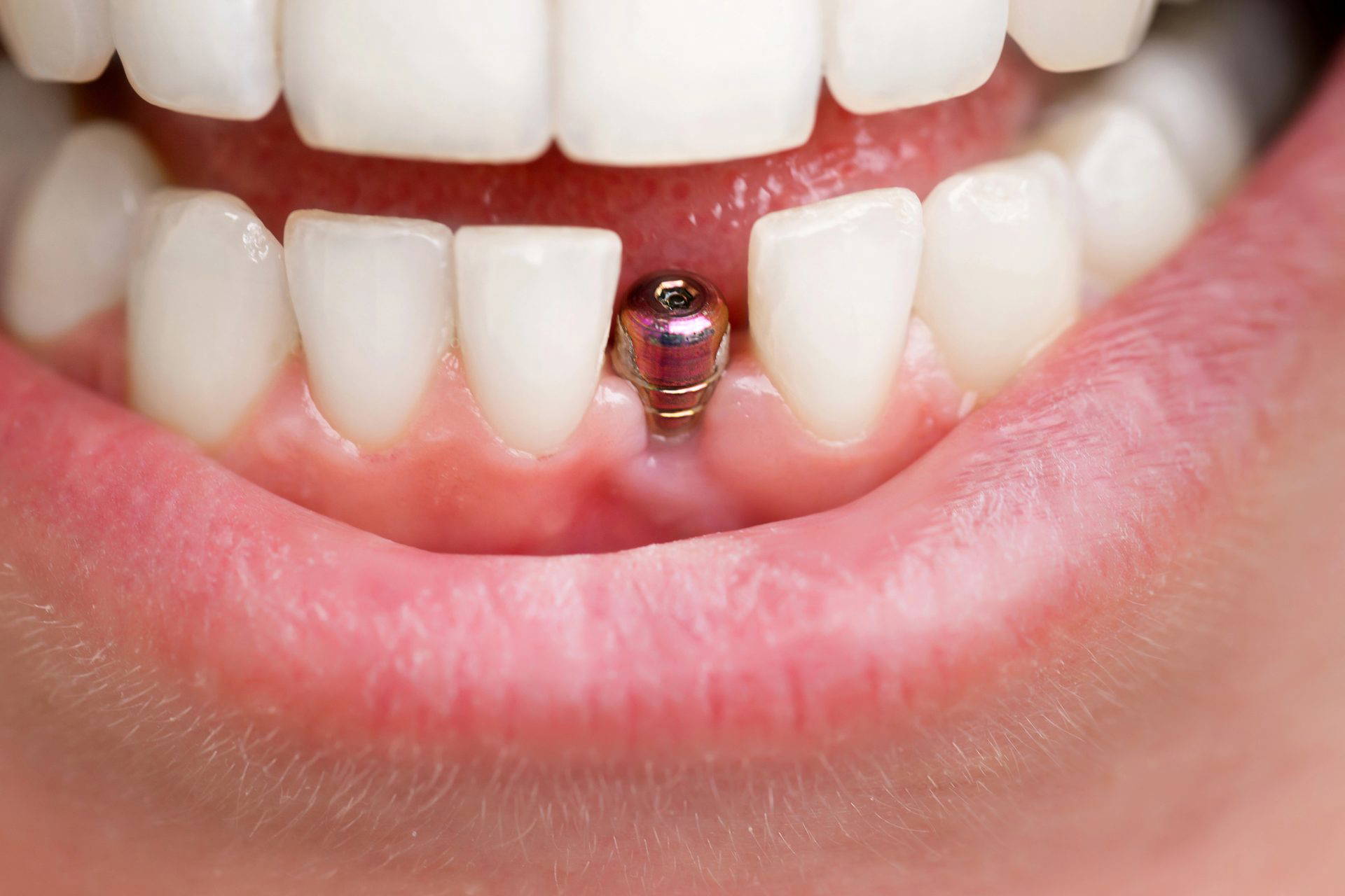 Close-up of a dental implant being fitted into a patient's mouth