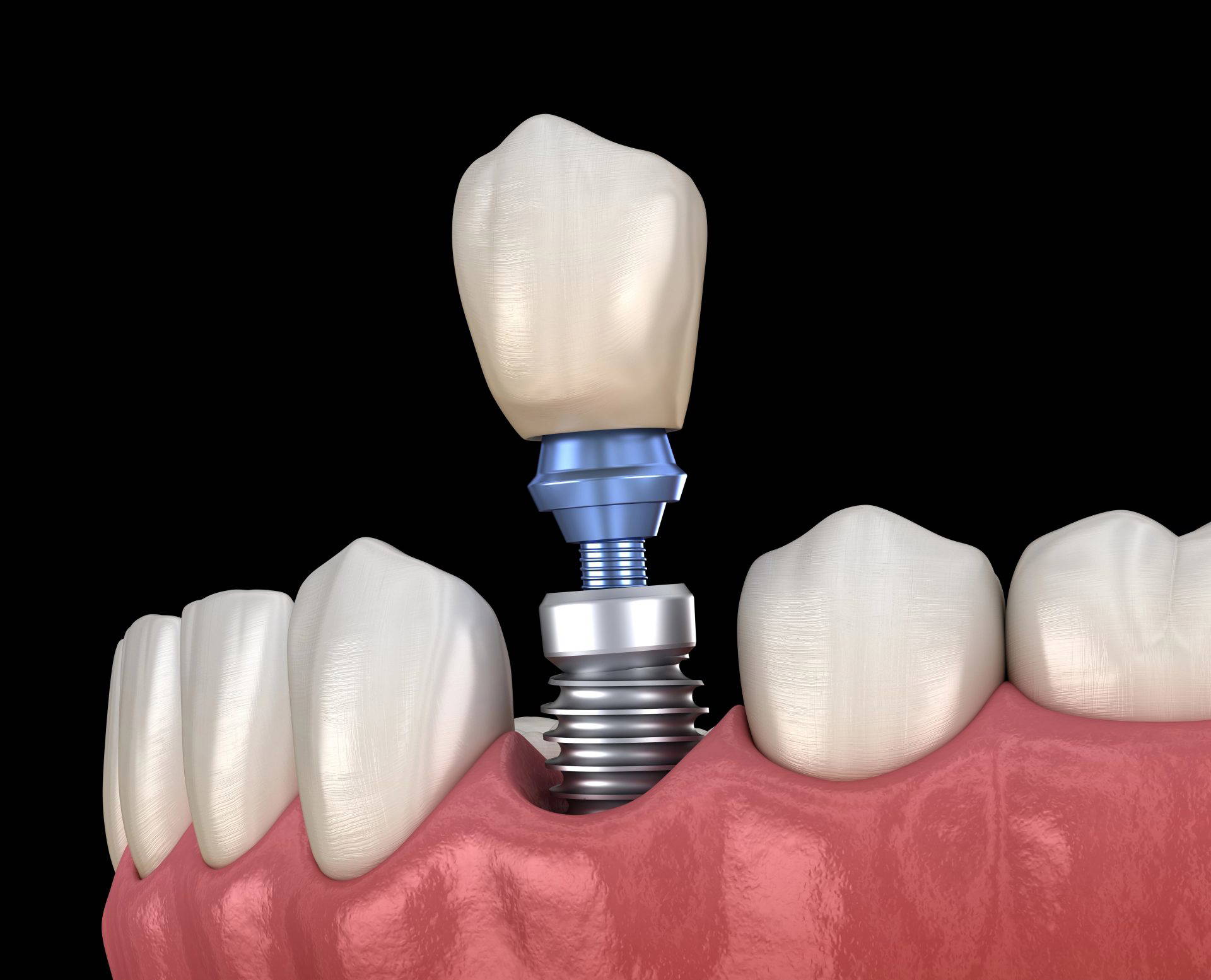 Illustration of a dental implant and crown inserted into the gum