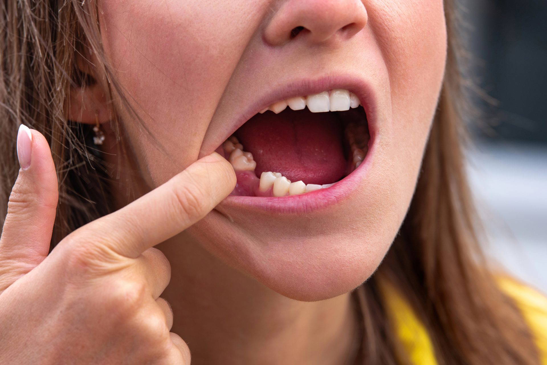 An image of a woman showing her mouth where a dental bridge would need to be placed.