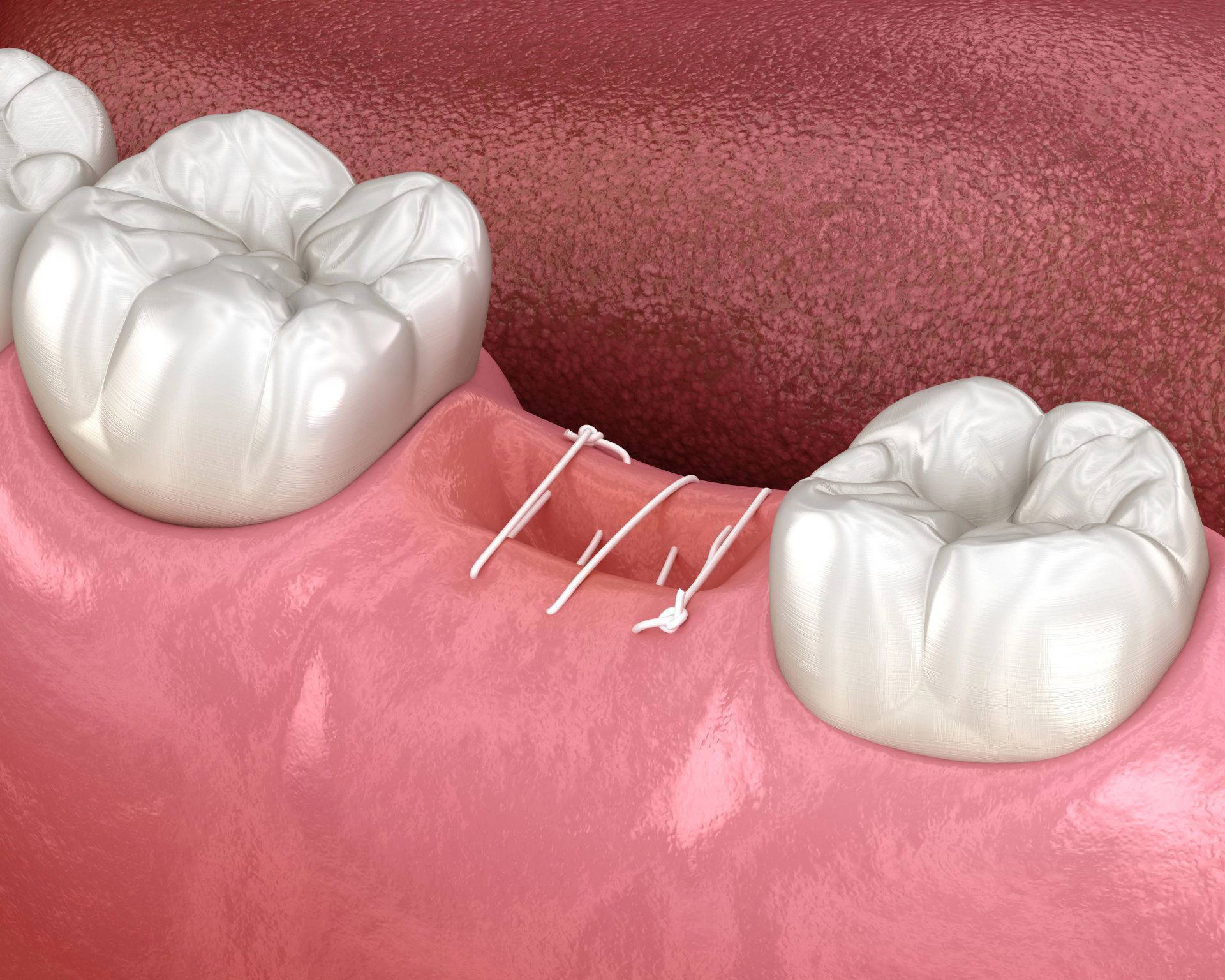 Dentist performing a tooth extraction procedure