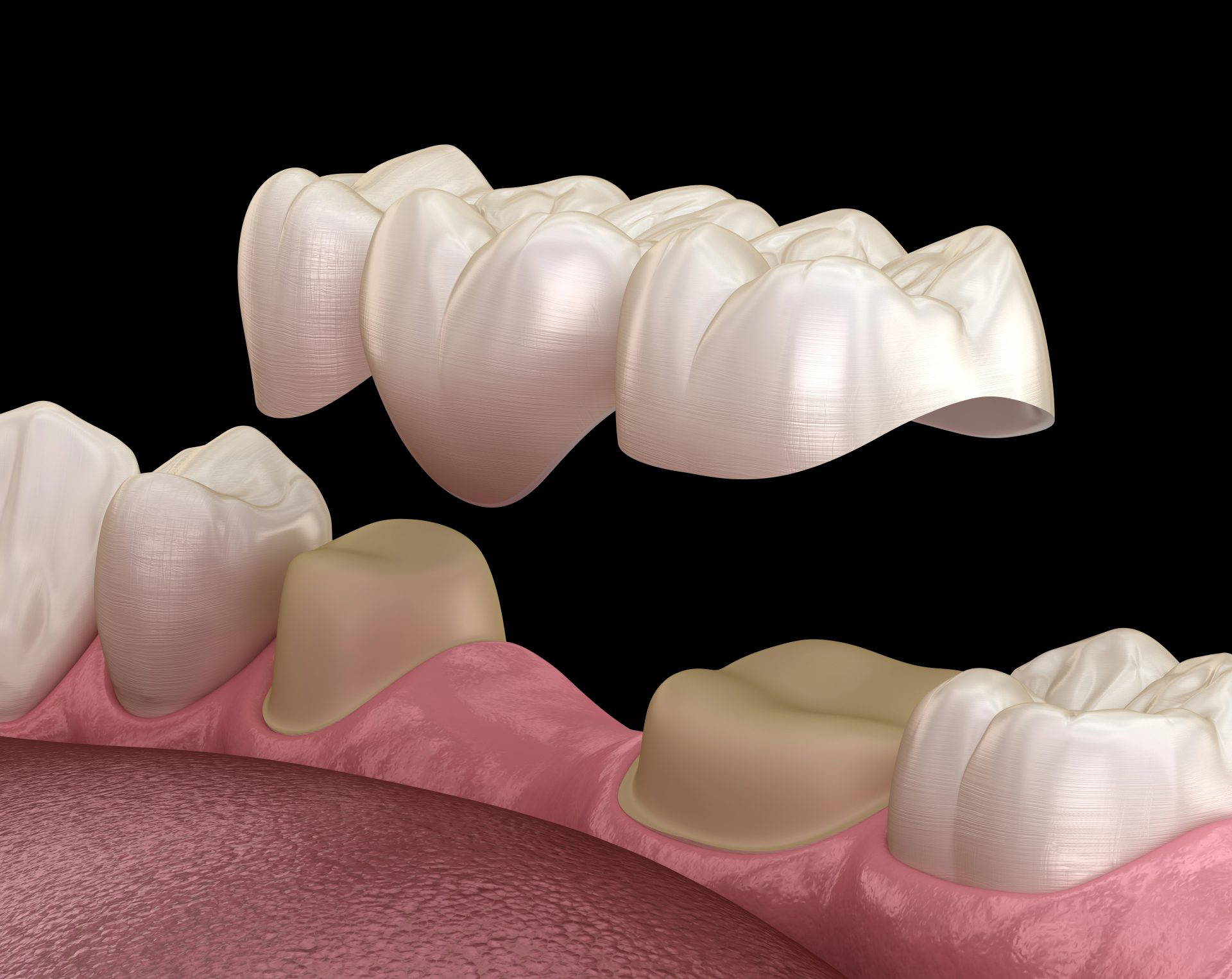 Close-up of a white dental crown being placed in a patient's open mouth