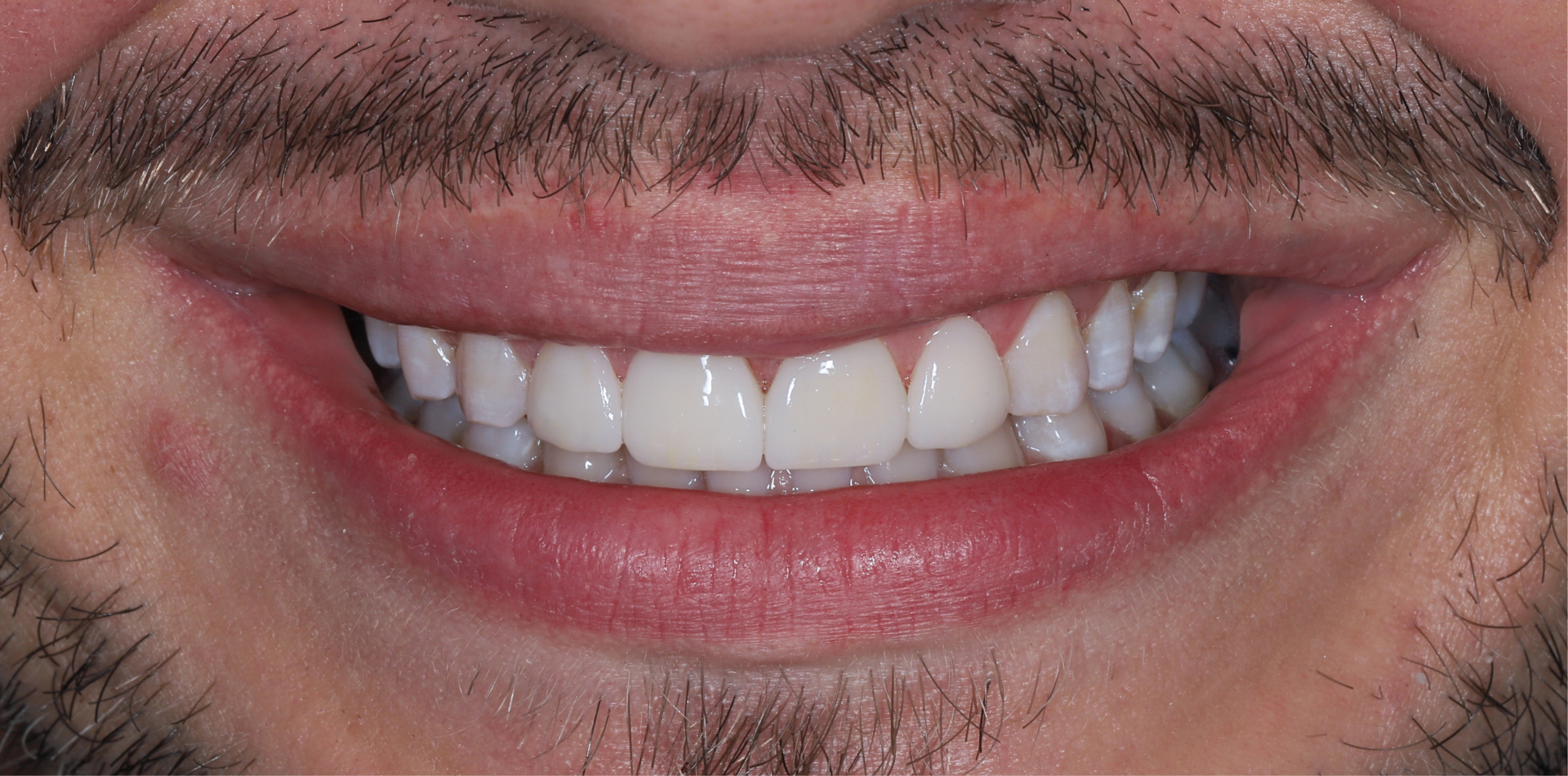 Beautiful white smile after dental veneers treatment – after photo
