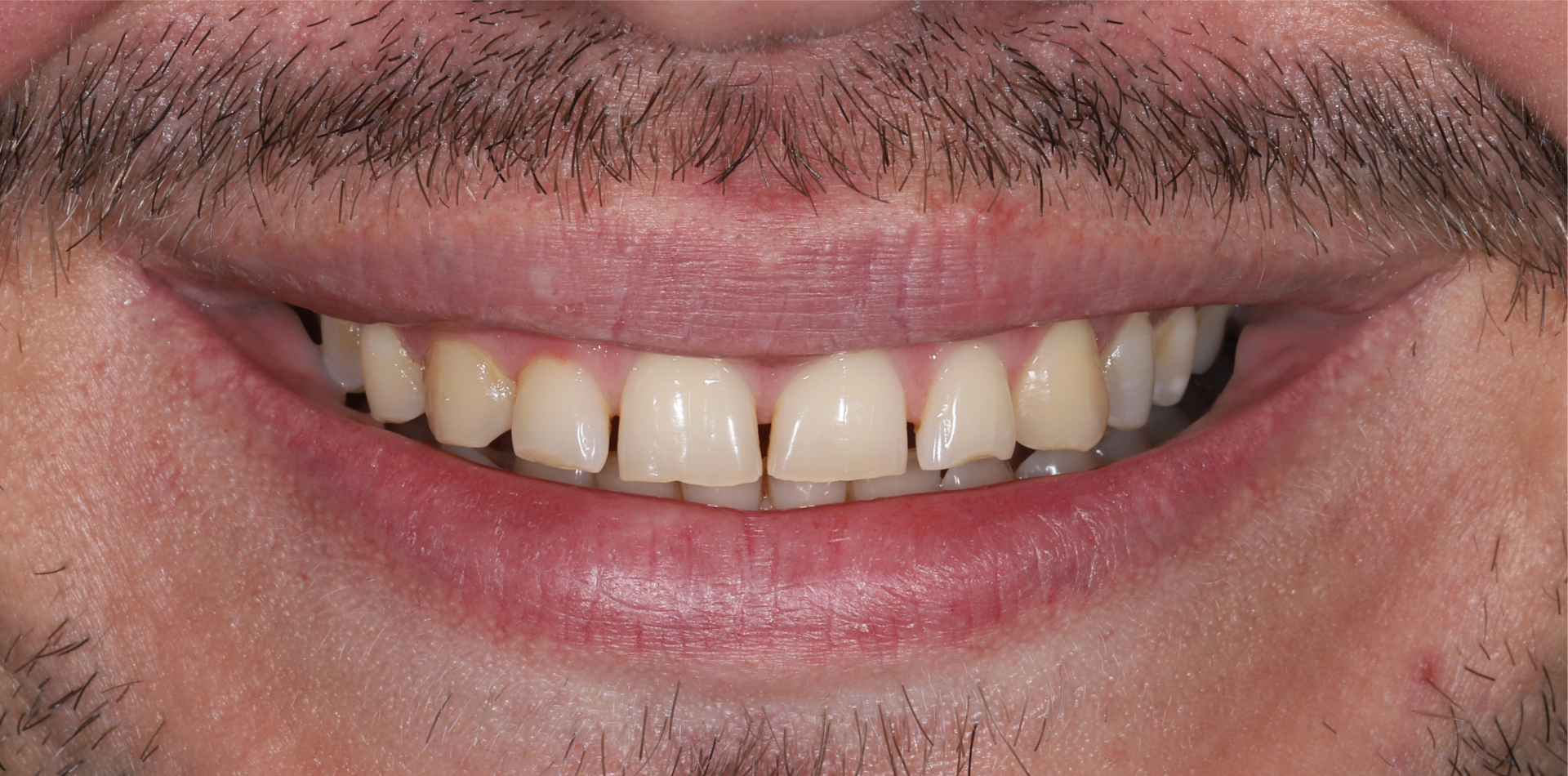 Natural smile before dental veneers treatment – before photo