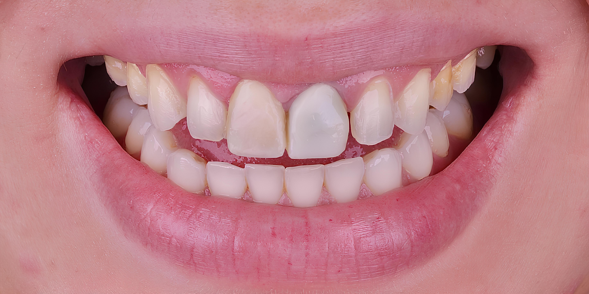 Close-up of teeth before dental veneer treatment – before photo