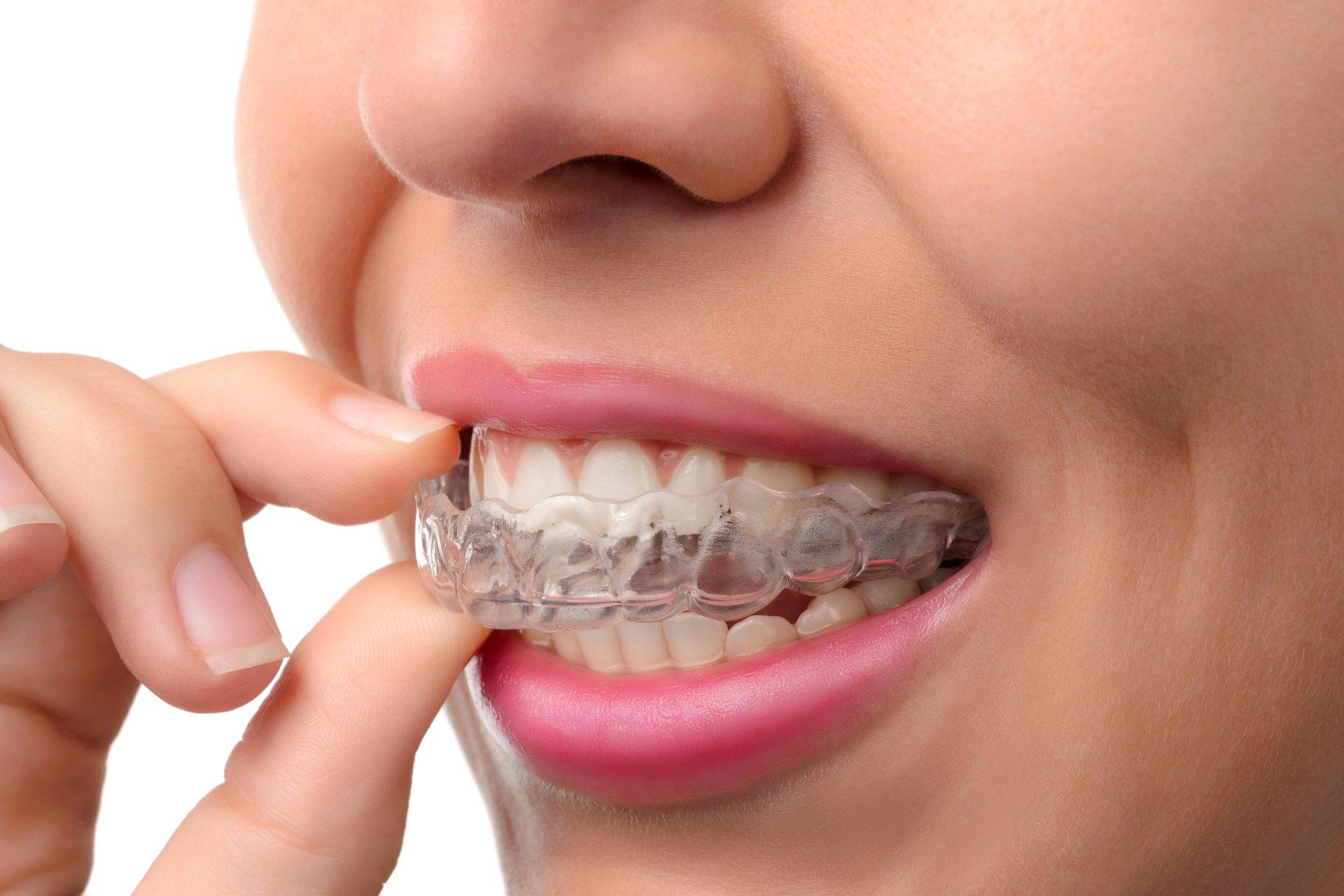 Close-up of teeth whitening trays being applied to a patient's teeth